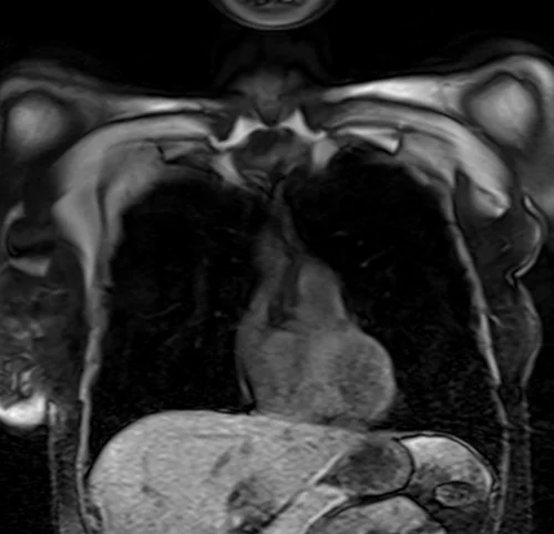 MRI chest coronal t1 image 1 - MRI