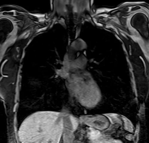 MRI chest coronal t1 image 2 - MRI