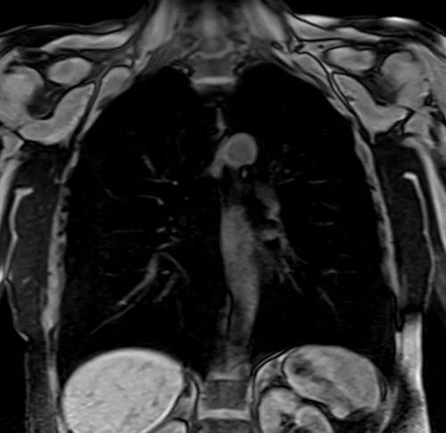 MRI chest coronal t1 image 3 - MRI