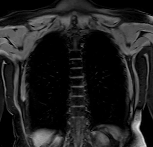 MRI chest coronal t1 image 4 - MRI