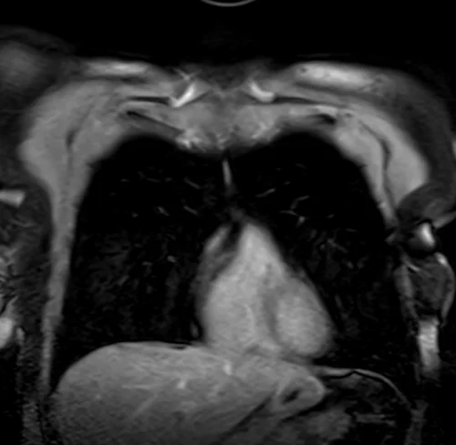 MRI chest coronal t1 post contrast image 1 - MRI
