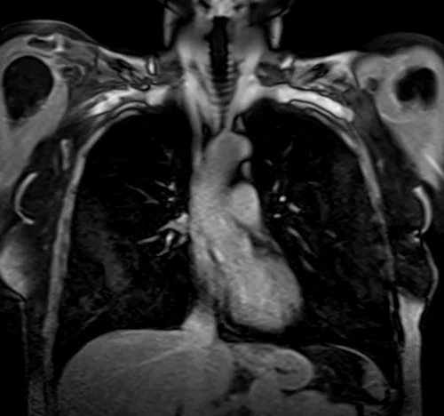 MRI chest coronal t1 post contrast image 2 - MRI