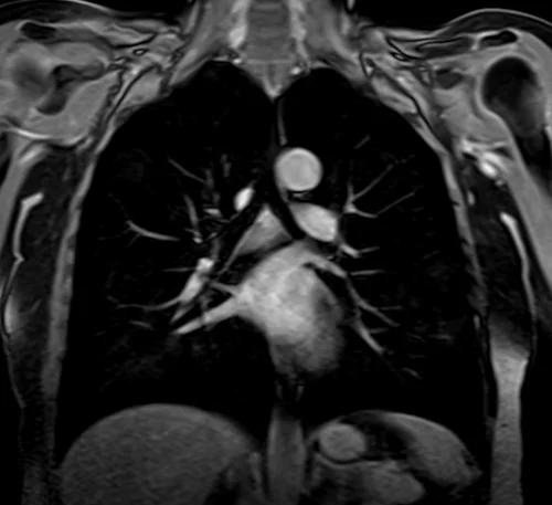 MRI chest coronal t1 post contrast image 3 - MRI