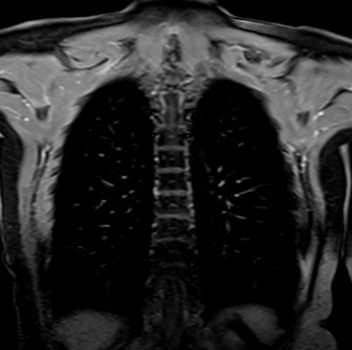 MRI chest coronal t1 post contrast image 4 - MRI