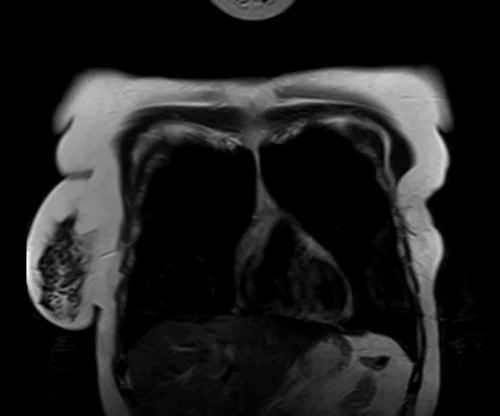 MRI chest coronal t2 image 1 - MRI