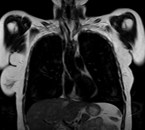 MRI chest coronal T2 TSE images