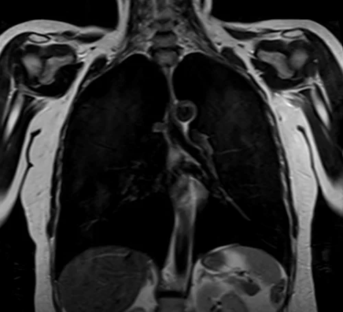 MRI chest coronal t2 image 3 - MRI