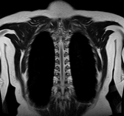 MRI chest coronal t2 image 4 - MRI