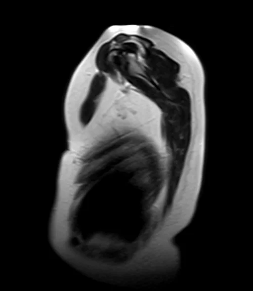 MRI chest sagittal t2 image 1 - MRI