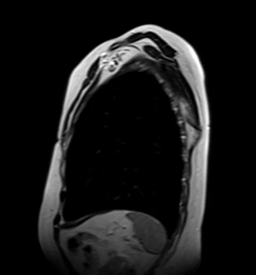 MRI chest sagittal t2 image 2 - MRI