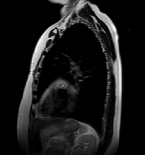 MRI chest sagittal t2 image 3 - MRI