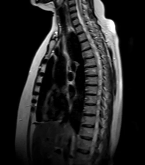 MRI chest sagittal t2 image 4 - MRI