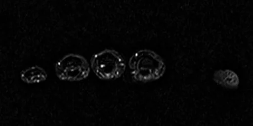 MRI hand axial stir image 1 - MRI