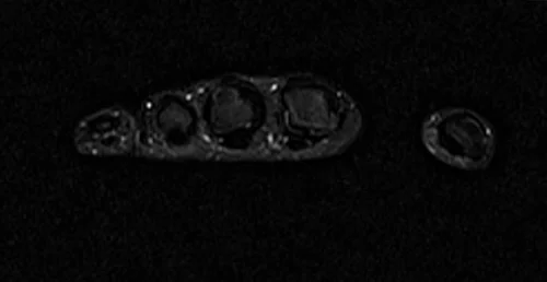 MRI hand axial stir image 2 - MRI