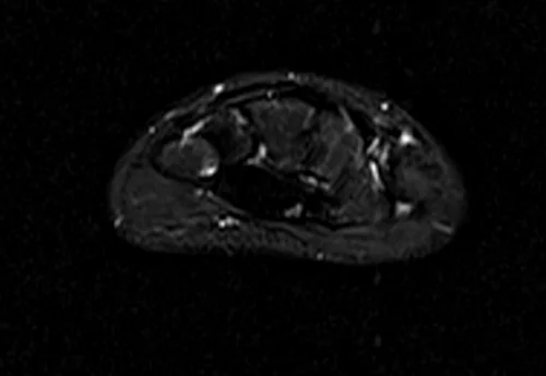 MRI hand axial stir image 4 - MRI