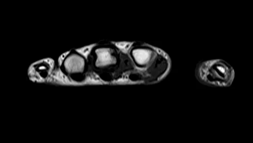 MRI hand axial t1 image 2 - MRI