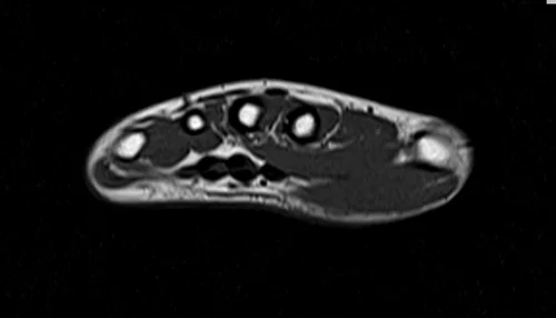 MRI hand axial t1 image 3 - MRI