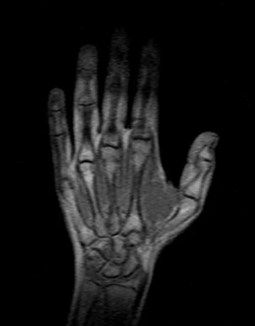 MRI hand localizer 1 - MRI