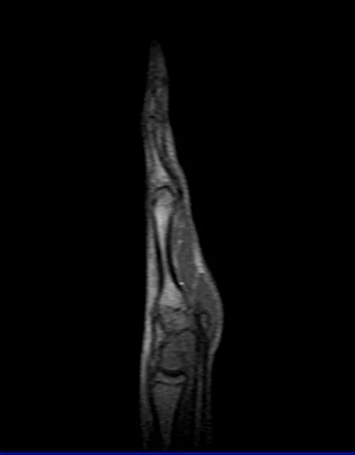 MRI hand localizer 2 - MRI