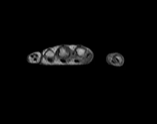 MRI hand localizer 3 - MRI