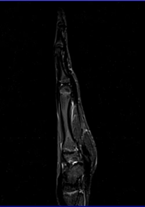 MRI hand sagittal stir image 1 - MRI