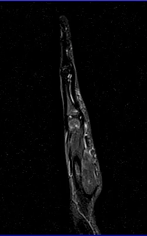 MRI hand sagittal stir image 2 - MRI