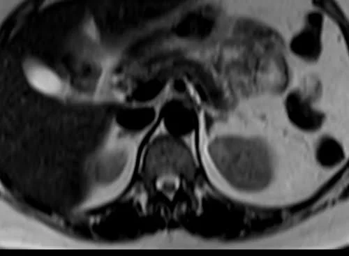MRI kidney ureters and bladder (KUB) axial t2 image 1 - MRI