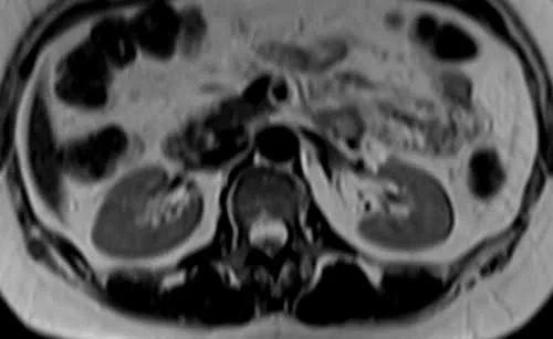 MRI kidney ureters and bladder (KUB) axial t2 image 2 - MRI