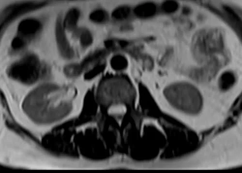 MRI kidney ureters and bladder (KUB) axial t2 image 3 - MRI