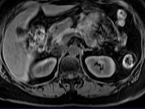 MRI kidney ureters and bladder (KUB) axial vibe fat sat image 1 - MRI