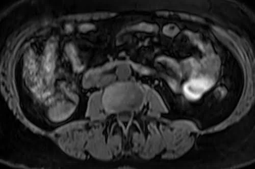 MRI kidney ureters and bladder (KUB) axial vibe fat sat image 3 - MRI
