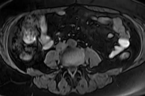 MRI kidney ureters and bladder (KUB) axial vibe fat sat image 4 - MRI