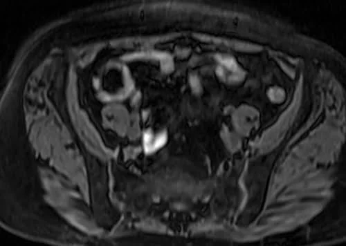 MRI kidney ureters and bladder (KUB) axial vibe fat sat image 5 - MRI