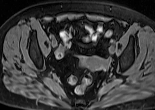 MRI kidney ureters and bladder (KUB) axial vibe fat sat image 6 - MRI