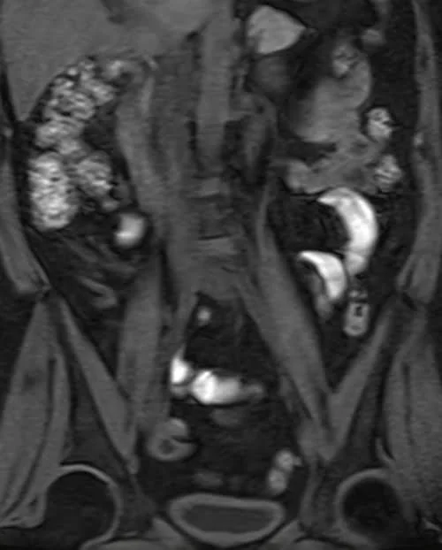 MRI kidney ureters and bladder (KUB) vine coronal fat sat image 1 - MRI