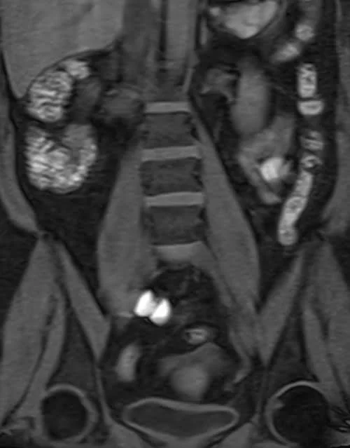 MRI kidney ureters and bladder (KUB) vine coronal fat sat image 2 - MRI