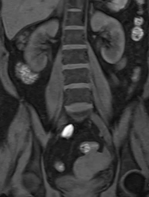 MRI kidney ureters and bladder (KUB) vine coronal fat sat image 3 - MRI