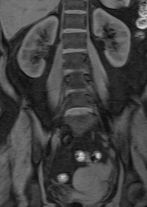 MRI kidney ureters and bladder (KUB) vine coronal fat sat image 4 - MRI