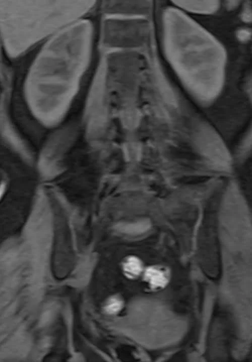 MRI kidney ureters and bladder (KUB) vine coronal fat sat image 5 - MRI