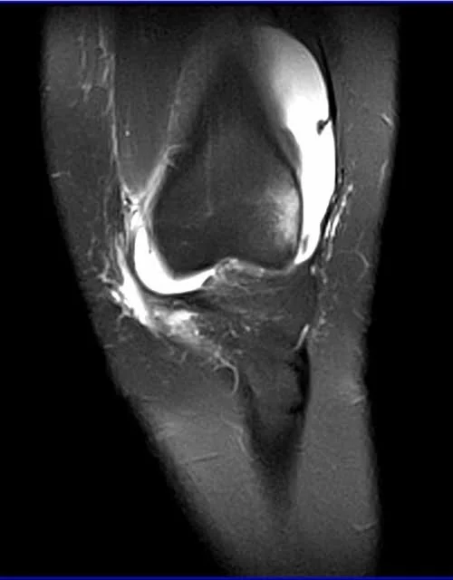 MRI knee coronal pd image 1 - MRI