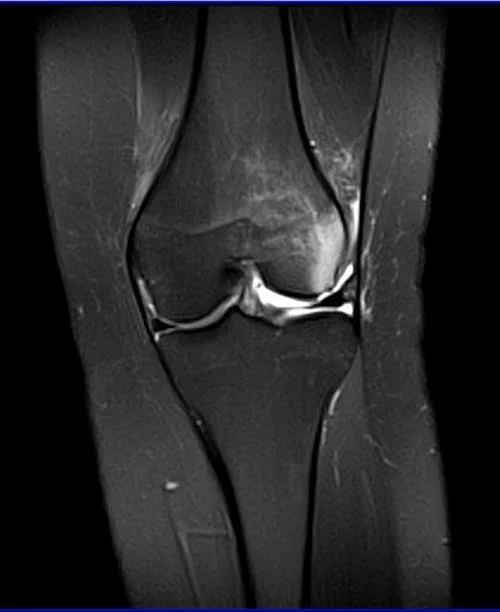 MRI knee coronal pd image 2 - MRI