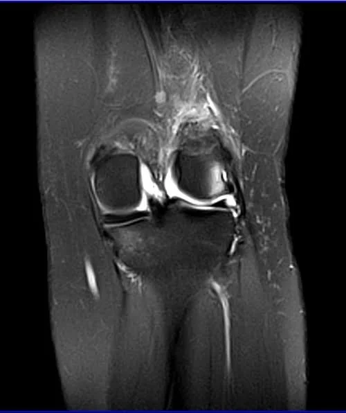 MRI knee coronal pd image 3 - MRI