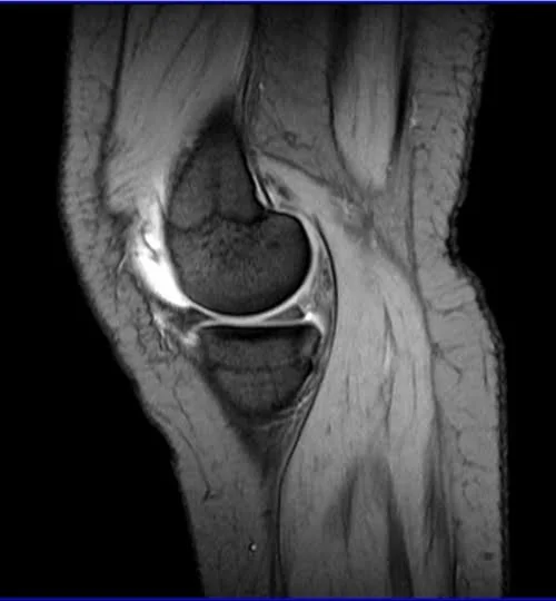 MRI knee sagittal medic 1 - MRI