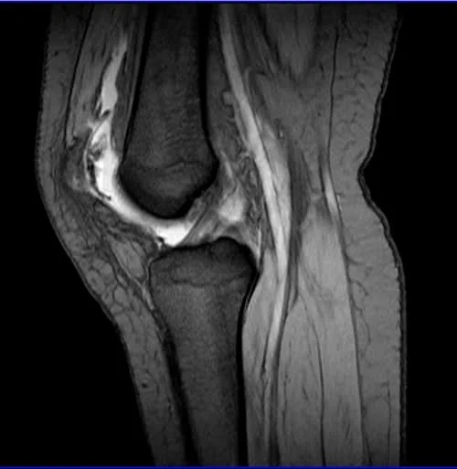 MRI knee sagittal medic 2 - MRI