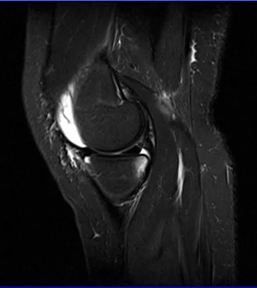 MRI knee sagittal stir 1 - MRI