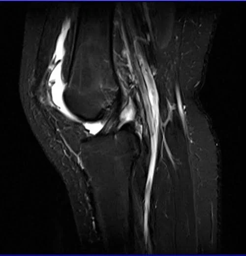MRI knee sagittal stir 2 - MRI