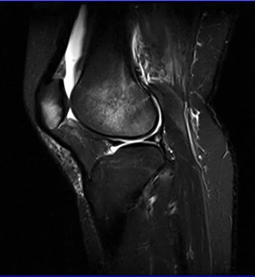 MRI knee sagittal stir 3 - MRI