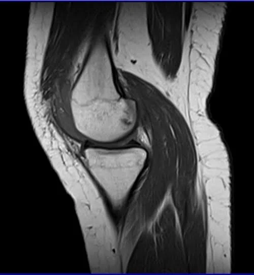 MRI knee sagittal t1 1 - MRI