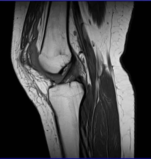 MRI knee sagittal t1 2 - MRI
