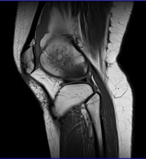 MRI knee sagittal t1 3 - MRI